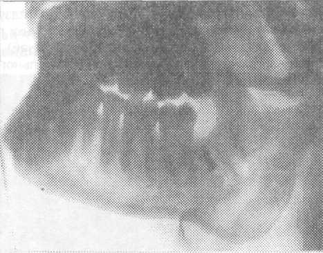 Отлом бугра верхней челюсти при удалении зуба лечение