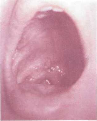 Герпетическая ангина полости рта