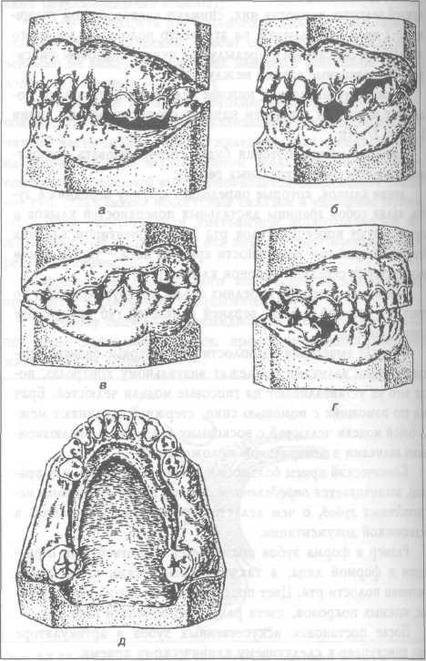 Ортопедическое лечение деформации зубов