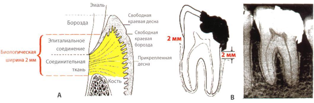 Схема десен. Биологическая ширина в стоматологии. Зона биологической ширины стоматология. Биологическая ширина зуба. Биологическое пространство зуба.