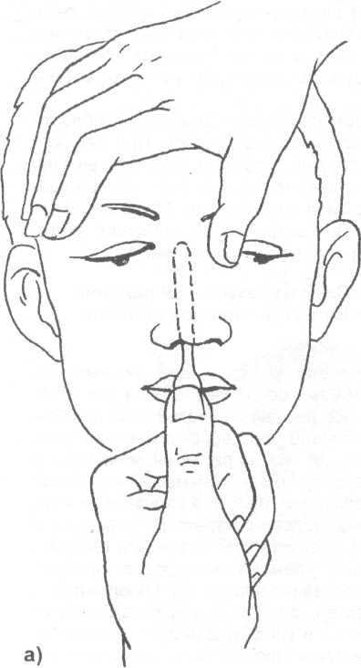 Можно вправить нос. Пальцевая репозиция костей носа. Инструментальная репозиция костей носа. Вправление перелома костей носа. Перелом костей носа репозиция.