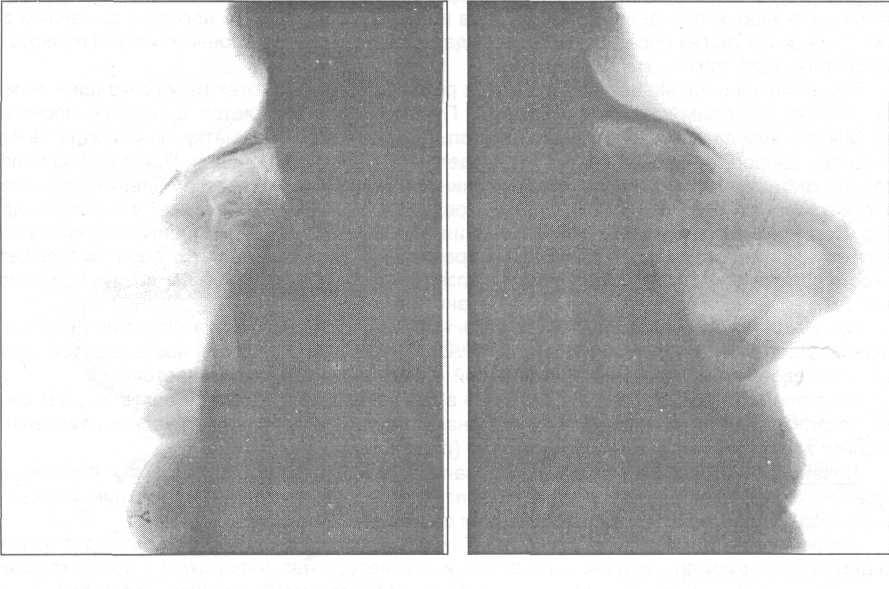 Описание рентгенограммы при переломе костей носа