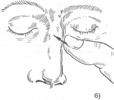 Перелом костей носа классификация