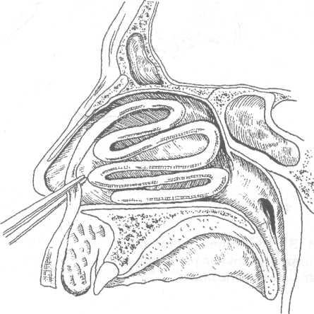 Описание рентгенограммы при переломе костей носа