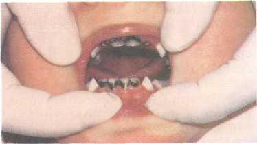Лечение кариеса постоянных зубов пломбировочным материалом thumbnail