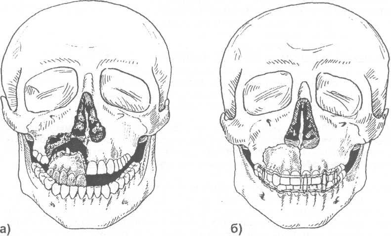 Перелом лицевого черепа. Оскольчатый перелом верхней челюсти. Лефор переломы верхней челюсти. Перелом верхней челюсти Лефор 1. Перелом альвеолярного отростка верхней челюсти.