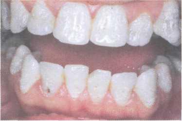 Наследственные нарушения развития зубов диагностика и лечение