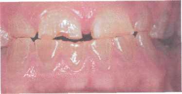 Наследственные нарушения развития зубов диагностика и лечение thumbnail