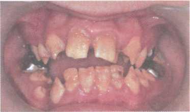 Лечения нарушения развития зубов