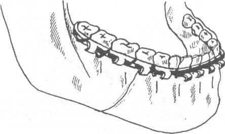 План лечения перелома нижней челюсти