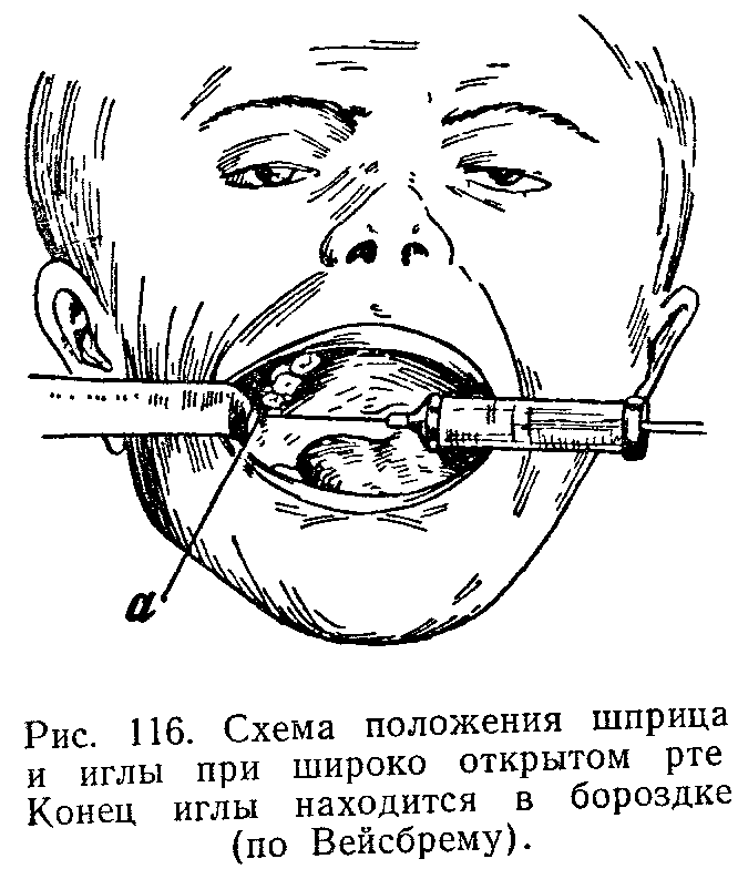 Мандибулярная анестезия в стоматологии схема