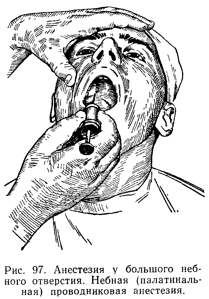 Анестезия полости рта
