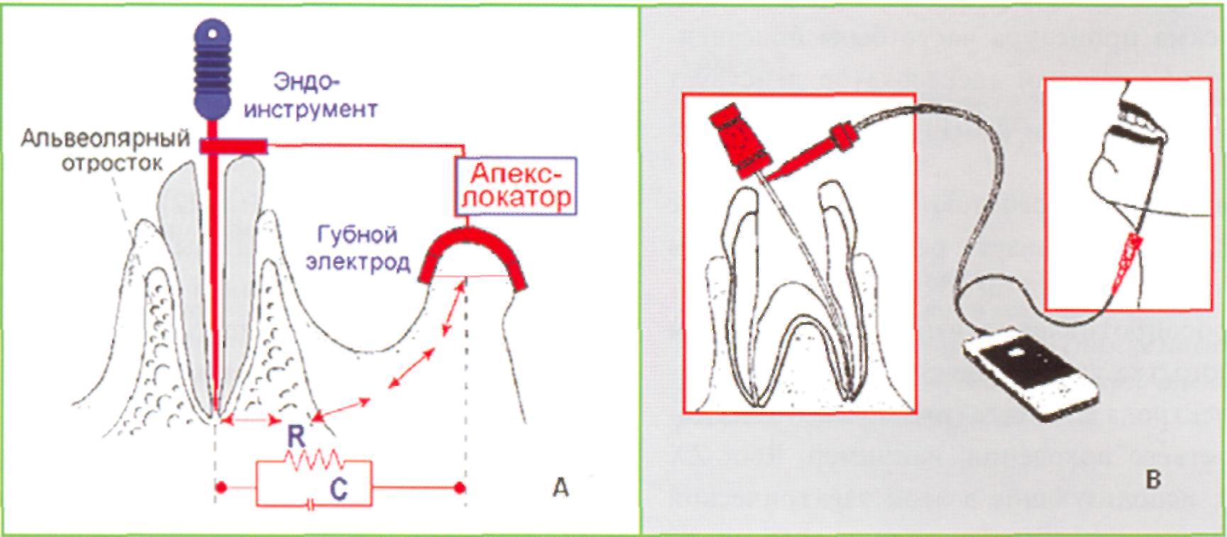 Определение корневых каналов. Импеданс в стоматологии. Прибор для измерения зубного канала. Апекслокация корневого канала. Апекслокация в стоматологии.