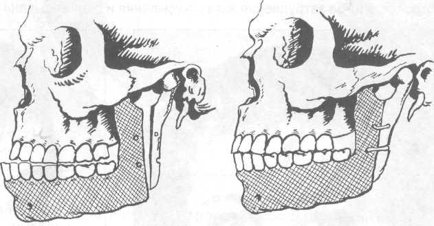 Прогения нижней. Прогения нижней челюсти. Сагиттальная остеотомия верхней челюсти. Макрогнатия нижней челюсти.