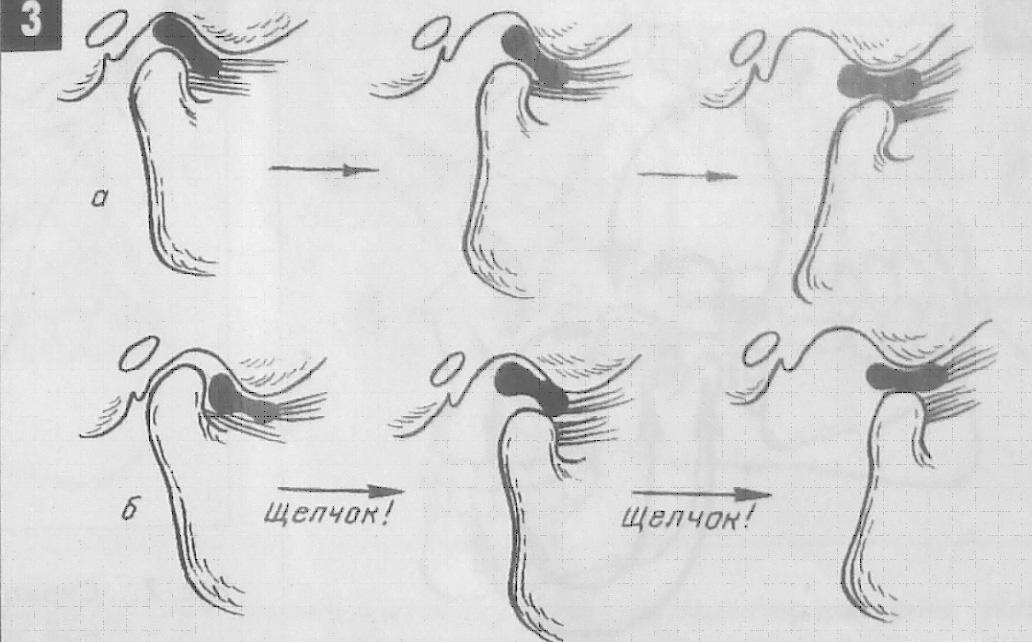 Вывих челюсти. Подвывих суставного диска ВНЧС. Вывих суставного диска височно-нижнечелюстного сустава.