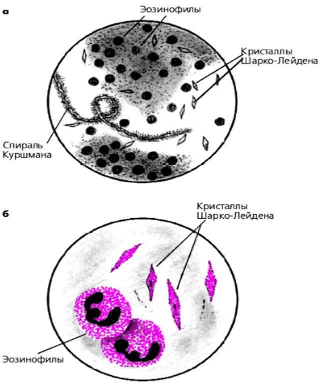 Шарко кале. Микроскопия мокроты при бронхиальной астме. Спираль Куршмана в мокроте нативный препарат. Микроскопия мокроты спирали Куршмана. Спирали Куршмана микроскопия.