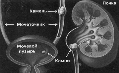 Мочеточники выходят из почки. Камень в Устье мочеточника. Конкремент н 3 левого мочеточника. Камень в мочеточнике перед мочевым пузырем.