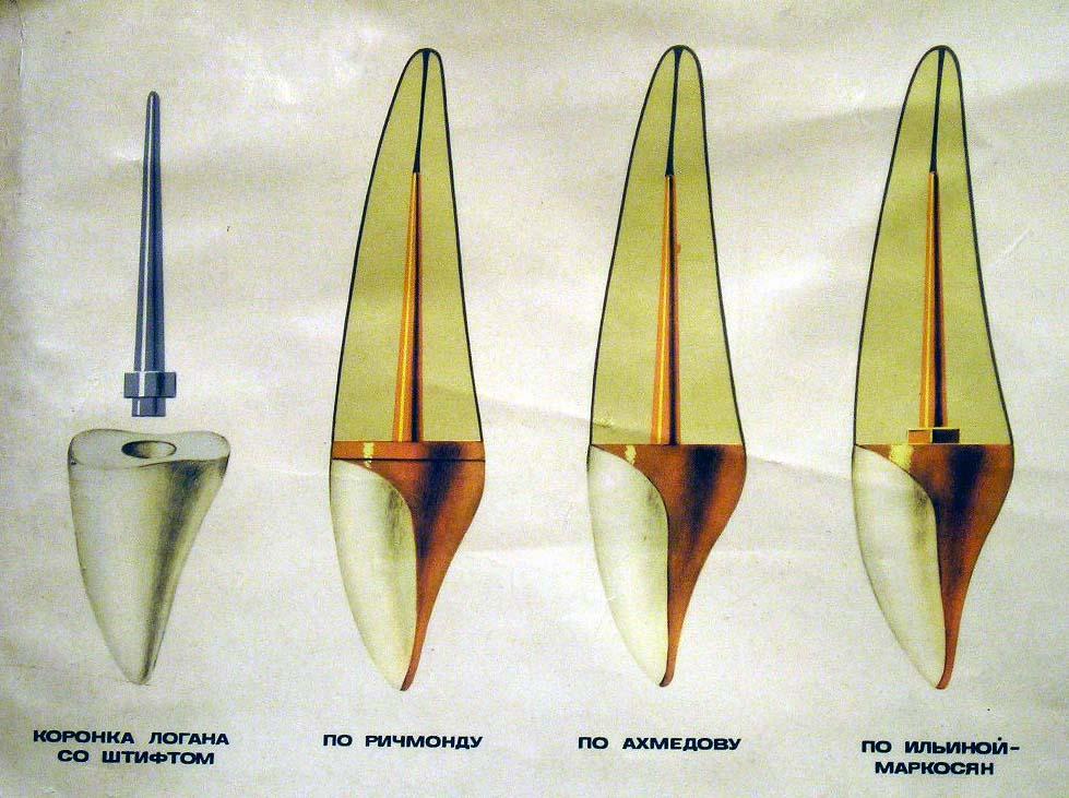 Штифтовые зубы. Штифтовой зуб по Ильиной-Маркосян. Штифтовые зубы Логана Дэвиса. Штифтовой зуб по Ричмонду. Штифтовые конструкции Ахмедову.