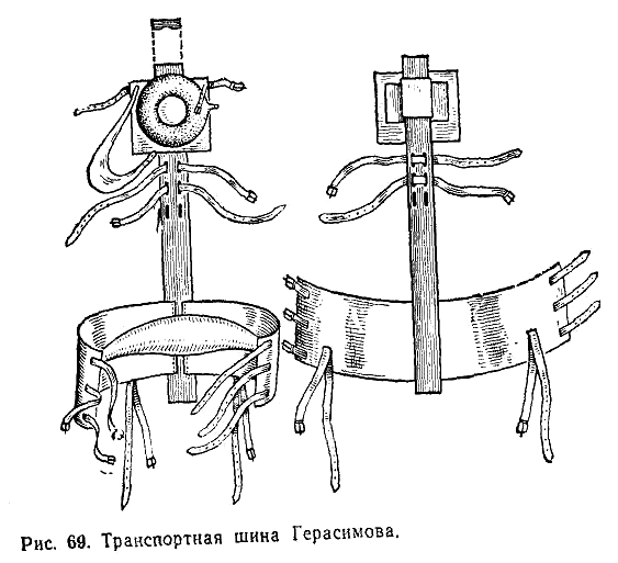 Техника наложения шин при транспортной иммобилизации