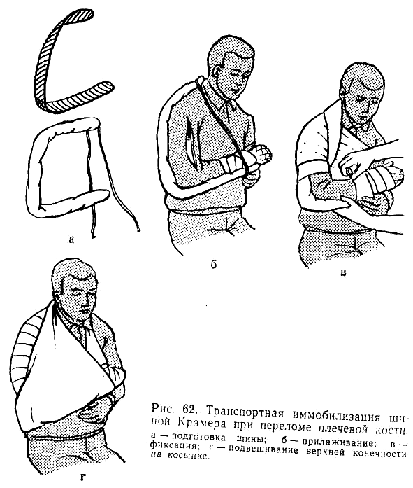 Техника наложения шин при транспортной иммобилизации