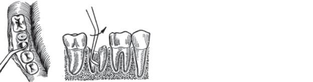 Удаление зуба семерки