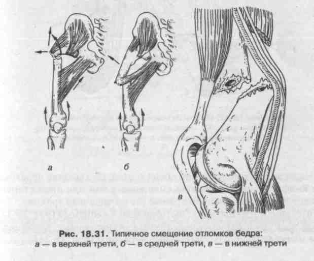 Нижняя треть верхнего бедра