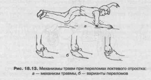 Перелом локтевого отростка восстановление. Направления перелома при падении на вытянутую руку. Биомеханическая травма.