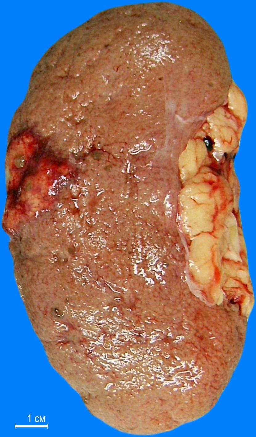 Апоптозное тельце при вирусном гепатите