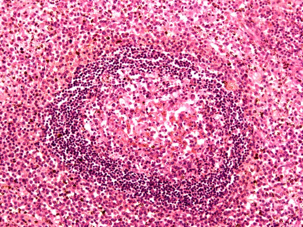 Апоптозное тельце при вирусном гепатите