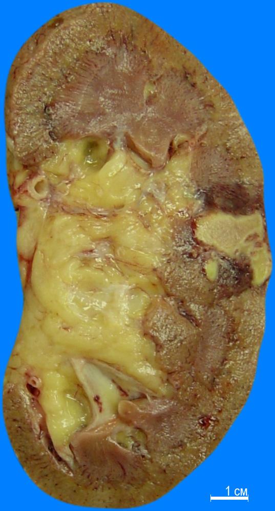 Апоптозные тельца каунсильмена при гепатите thumbnail