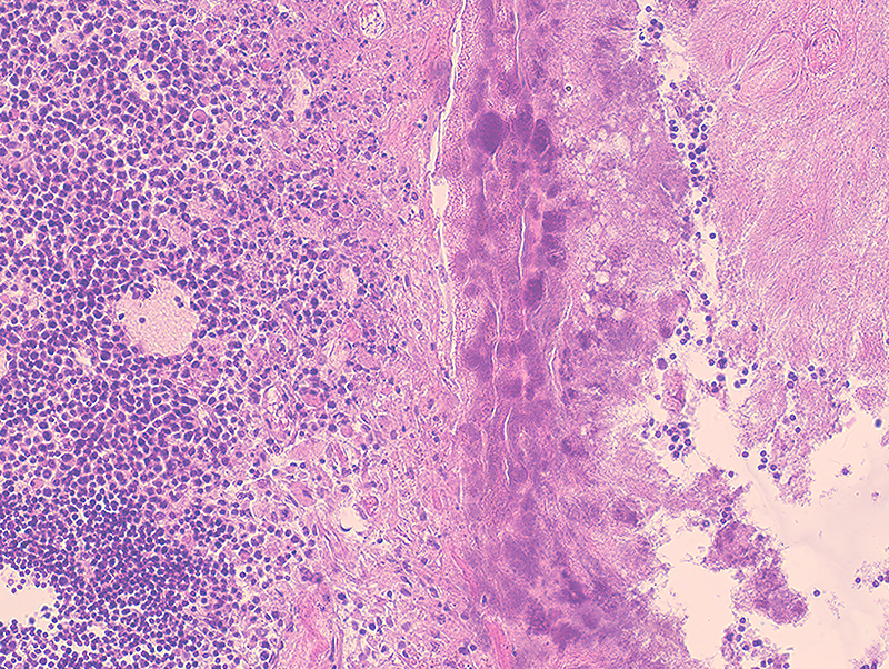 Апоптозные тельца каунсильмена при гепатите