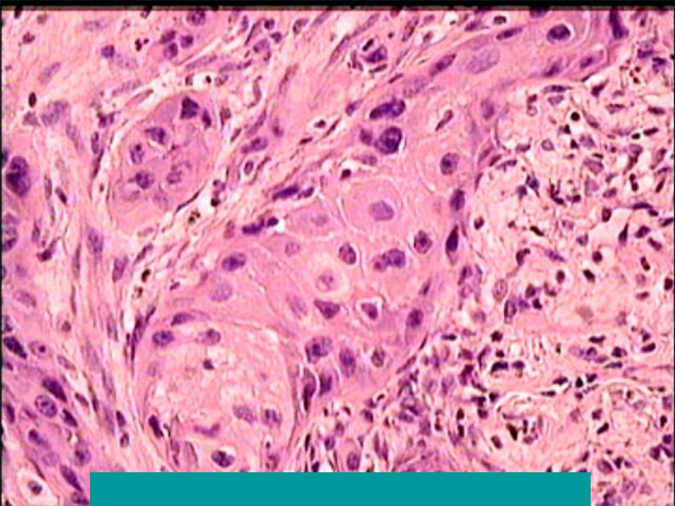 Плоскоклеточный неороговевающий рак шейки