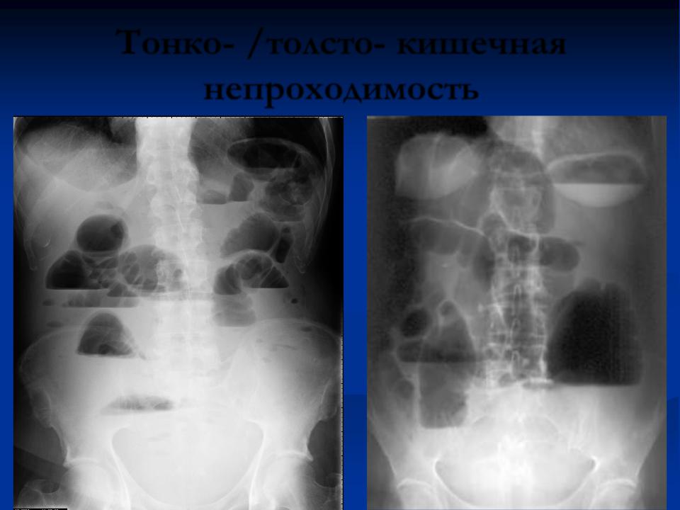 Тонкокишечная непроходимость