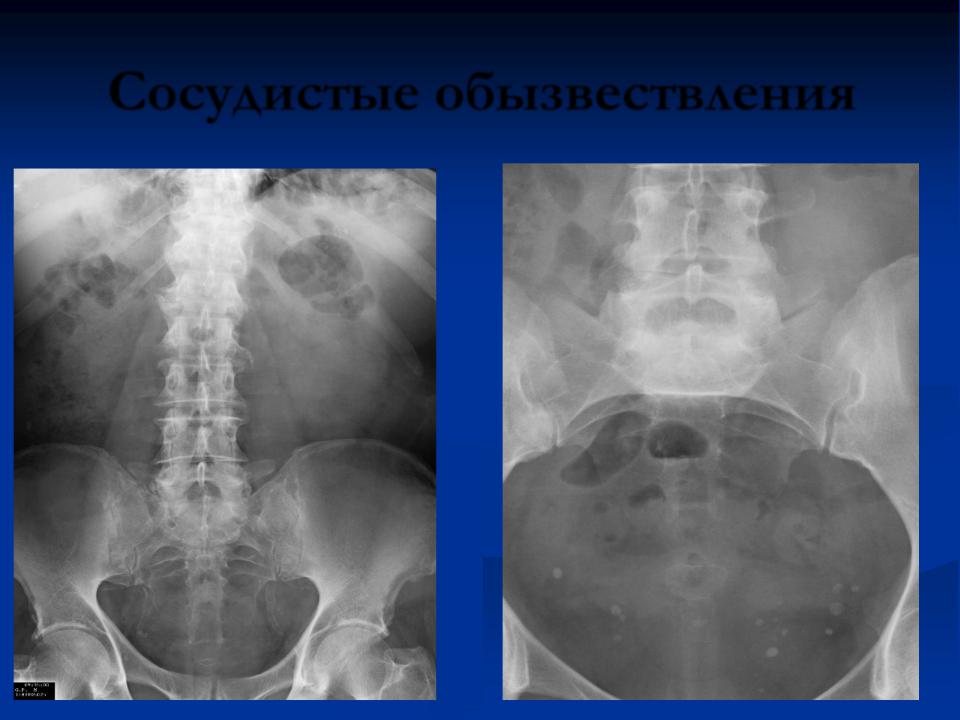 Сосудистое обызвествление. Обызвествление брюшной аорты. Кальциноз аорты на рентгенограмме. Обызвествление аорты рентген. Кальциноз брюшной аорты.