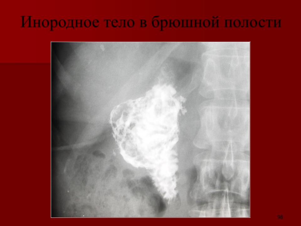 Инородное тело брюшной полости после операции. Рентген брюшной полости инородное тело. Инородное тело металлической плотности. Металлическое инородное тело на рентгене. Свободный ГАЗ В брюшной полости на рентгенограмме.