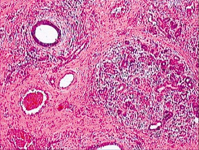 Синовит при ревматоидном артрите микропрепарат