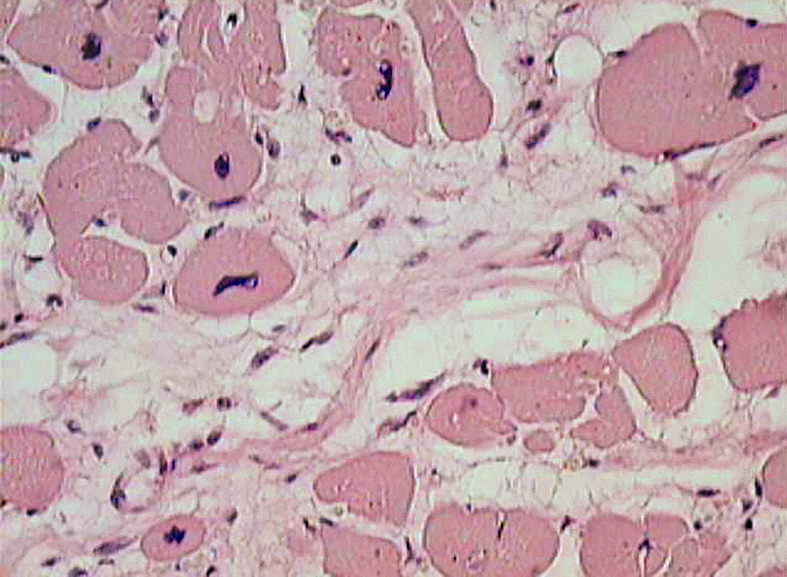 Синовит при ревматоидном артрите микропрепарат