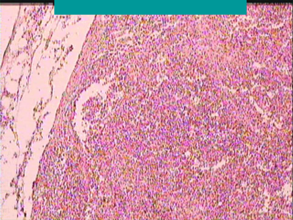 Реактивная гиперплазия лимфоузла. Брюшнотифозные гранулемы. Мезентериальный лимфоузел при брюшном тифе микропрепарат.