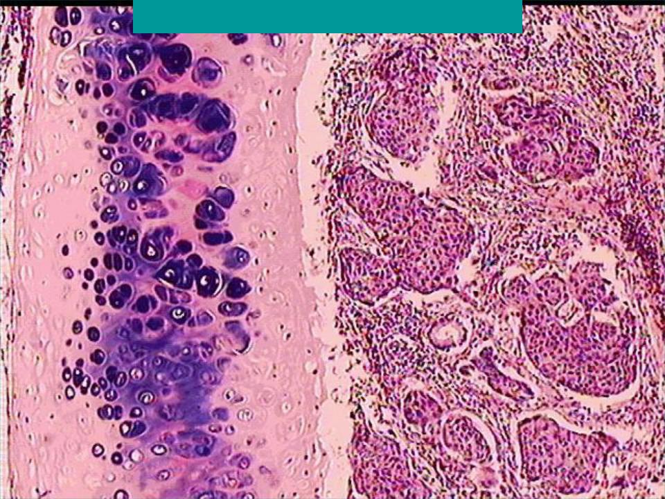 Стадии рака легких плоскоклеточный. Плоскоклеточная карцинома шейки матки гистология. Плоскоклеточная карцинома легкого микропрепарат. Плоскоклеточная карцинома гистология. Меланома микропрепарат патанатомия.
