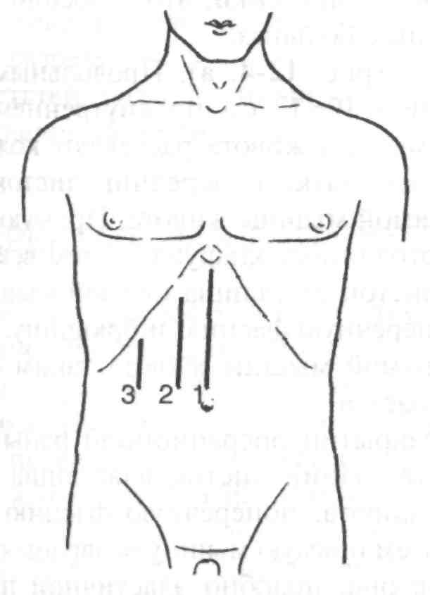 Какое лапаротомия. Верхняя трансректальная лапаротомия. Трансректальная левосторонняя лапаротомия. Разрез при срединной лапаротомии. Оперативные доступы к органам верхнего отдела брюшной полости.
