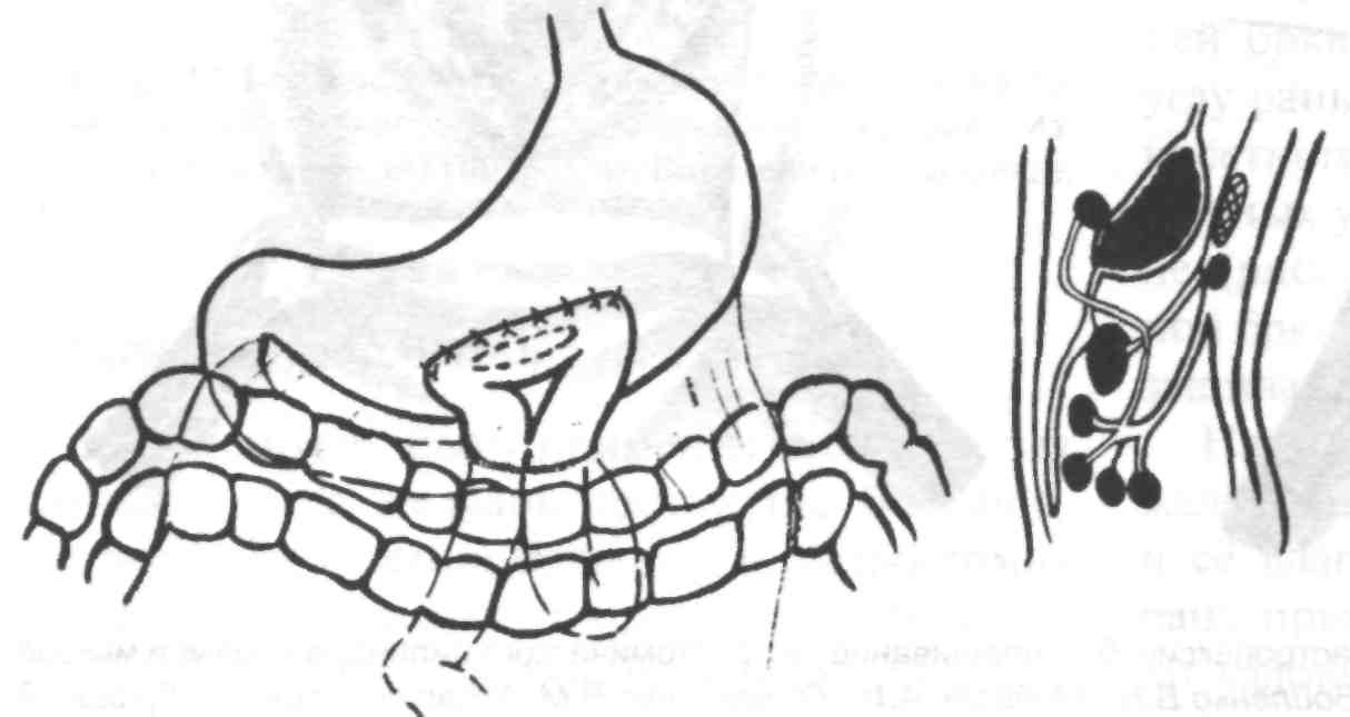 Анастомоз по брауну схема