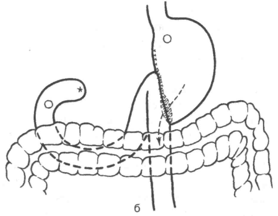 Резекция желудка по витебскому схема операции