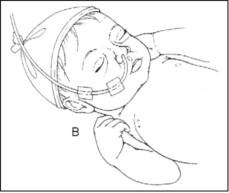 Зонд осложнения. Кормление ребенка через назогастральный зонд. Техника кормления ребенка через назогастральный зонд. Кормление новорожденного ребенка через назогастральный зонд. Питание через назогастральный зонд новорожденного.