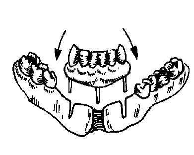 Ортопедическое лечение при ложных суставах челюстей