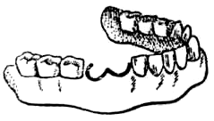 Переломы челюстей ложный сустав микростомия лечение