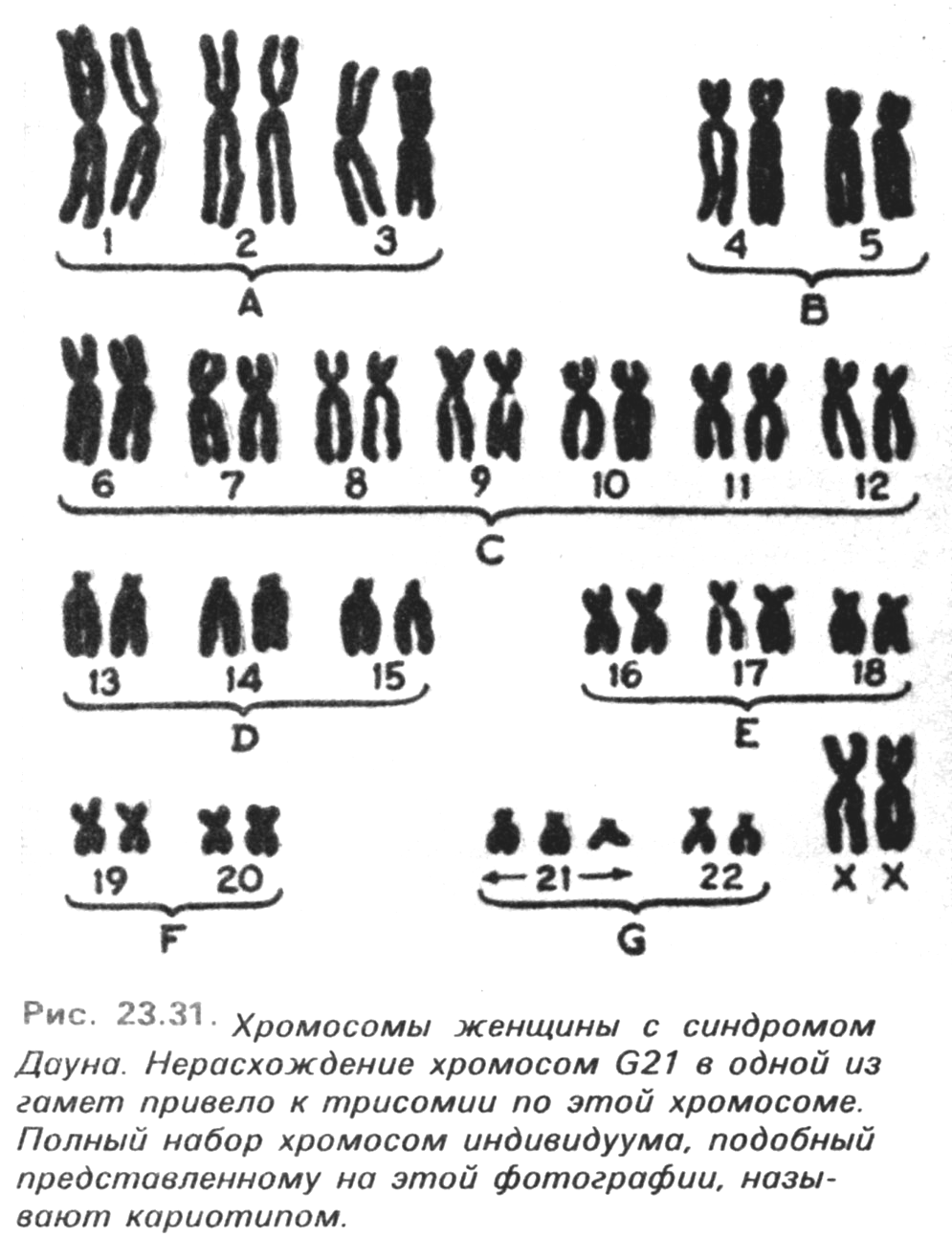 Схема хромосомного набора. Синдром Дауна хромосомная карта. Синдром Дауна 21 хромосома. Синдром Дауна схема хромосом. Хромосомный набор человека с синдромом Дауна.