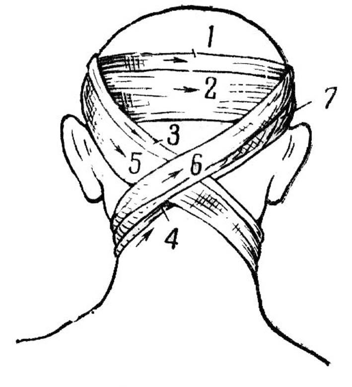 Повязки на голову шею. Крестообразная повязка на затылок и шею. Крестообразная повязка на затылок алгоритм. Крестообразная повязка на заднюю поверхность шеи. Техника наложения восьмиобразной повязки на затылочную область.