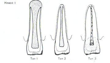 Методы лечения переломов зубов