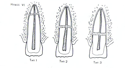 Методы лечения переломов зубов