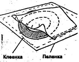 Профилактика пролежней беседа с родственниками пациента